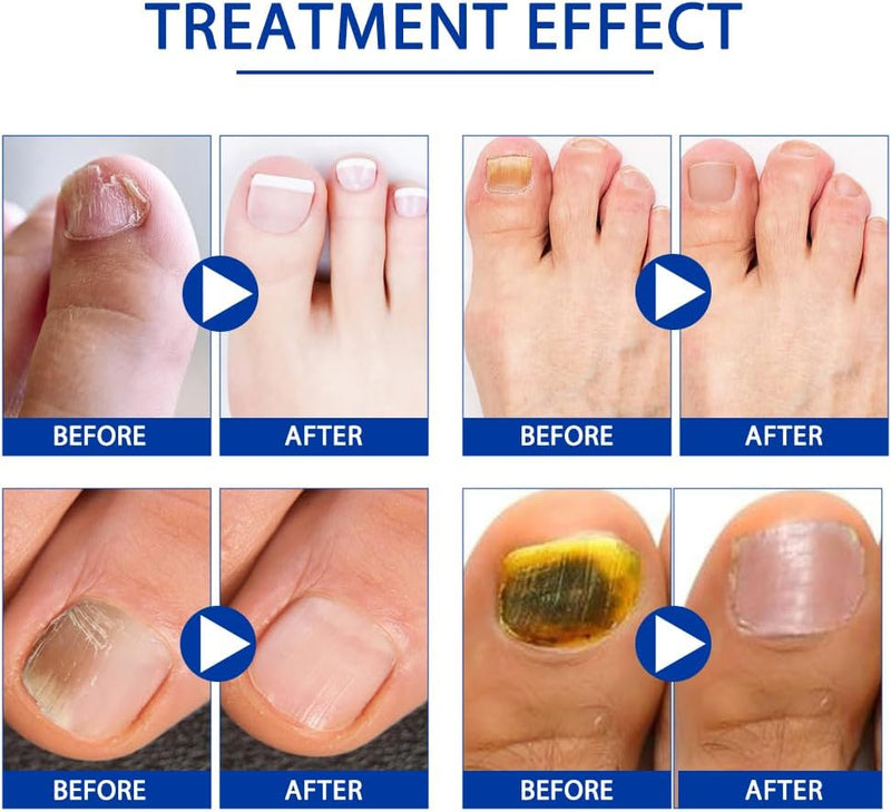 Fungal Nail Patches, 128 PCS Fungal Nail Treatment, Nail Fungus Treatment for Toenail, Fungal Toenail Treatment 8 Hour Nighttime Renewal Nail Fungus Treatment for Toenail